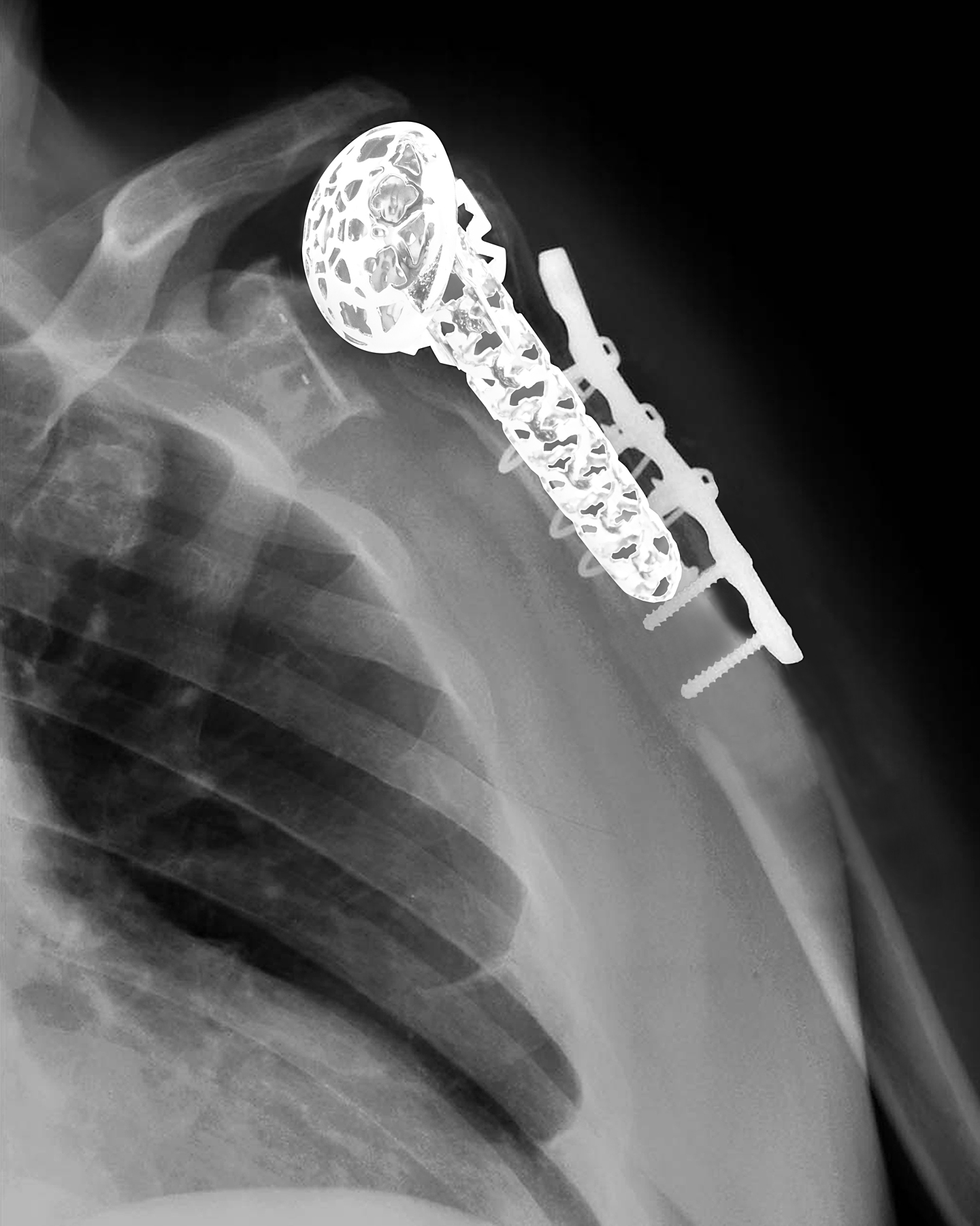 x-ray image of Shoulder Replacement – Mrs. Bjerk